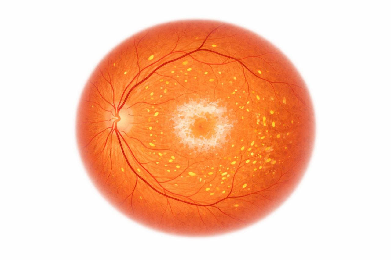 Fotografia de fons d'ull que mostra la lesió vitel·liforme característica de la Malaltia de Best: acumulació de material groguenc a la màcula amb aspecte de rovell d'ou, envoltada d'un halo fosc.
